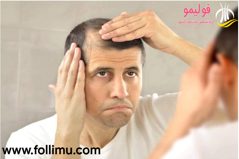 ریزش مو ناشی از فشار عصبی