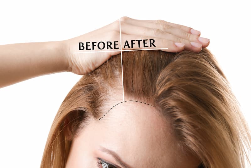 کوتاه کردن پیشانی با کاشت مو