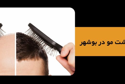 بهترین کلینیک کاشت مو دربوشهر